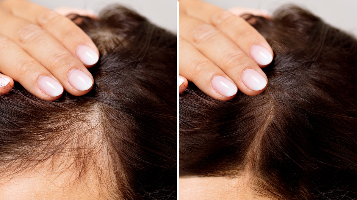 Hair Loss Solutions